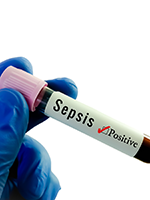 Sepsis Assessment and Reporting: Tips for Nursing Staff